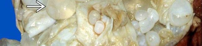 hydatid cyst hydatid cyst